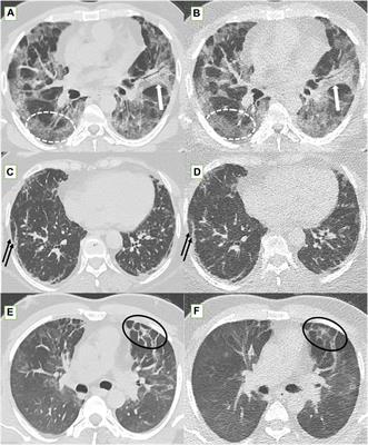 Evaluating Lung Changes in Long COVID: Ultra-Low‐Dose vs. Standard‐Dose CT Chest